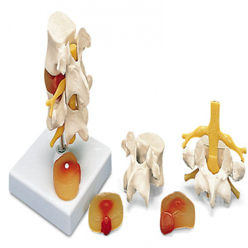 2节腰椎带2个病变椎间盘模型